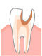 C3：神経まで達した虫歯
