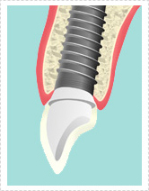 インプラント