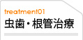 虫歯・根管治療