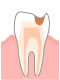 C2：象牙質の虫歯 