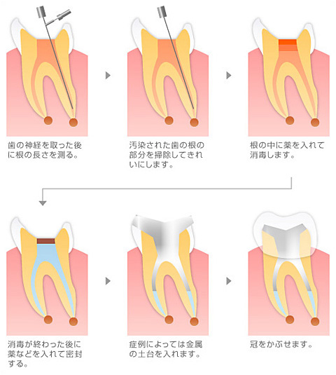 根管治療