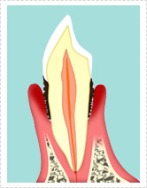 歯周病・再生療法
