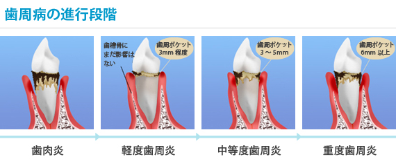 歯周病の進行段階